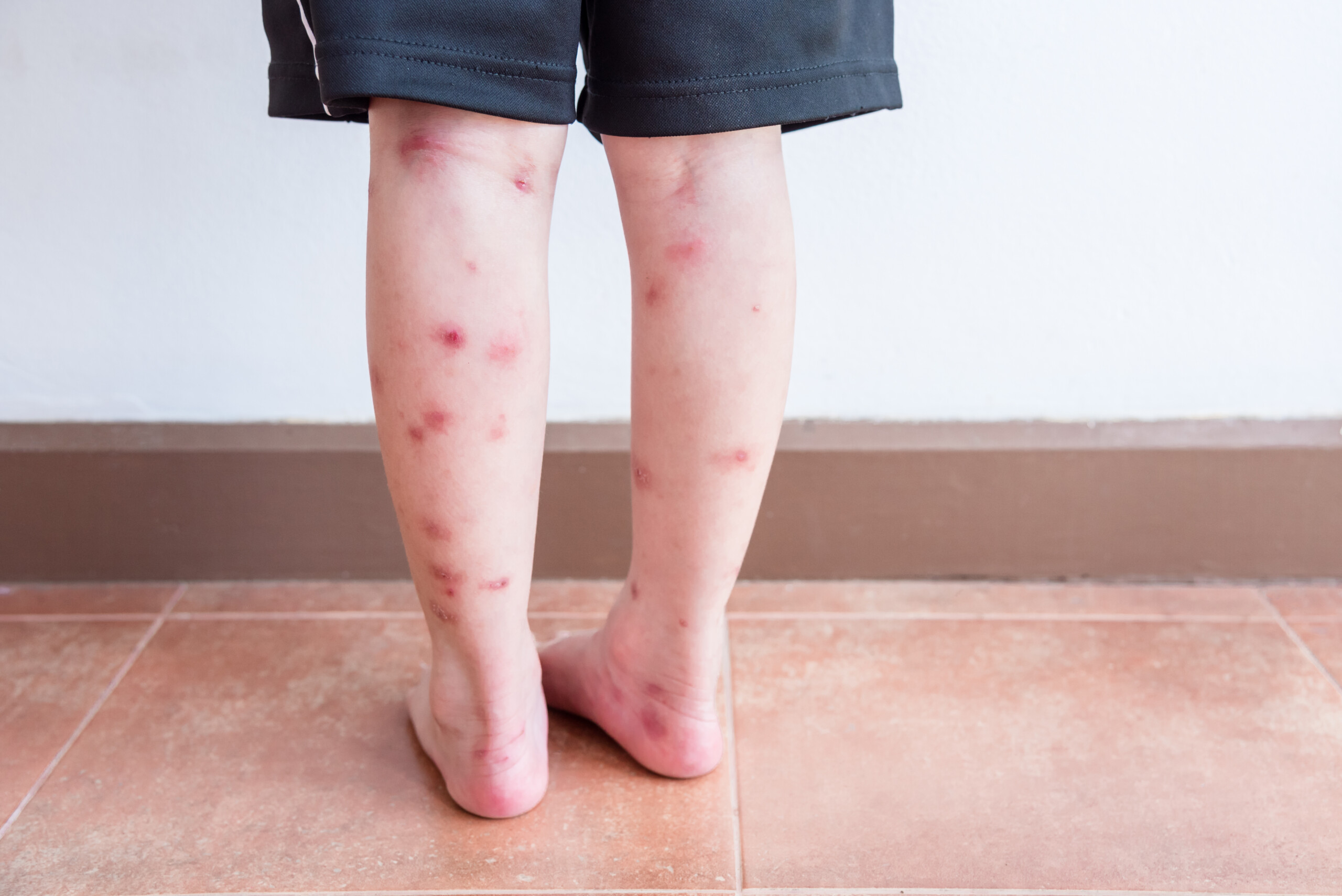 Child’s,Legs,With,Many,Red,Spot,And,Scar,From,Insect Alergia a picada de mosquito